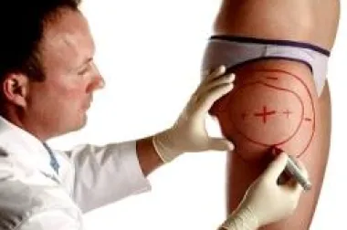 Liposukcija – do manje centimetara za samo nekoliko sati